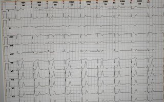 De Winter综合征全面解析与典型病例报告