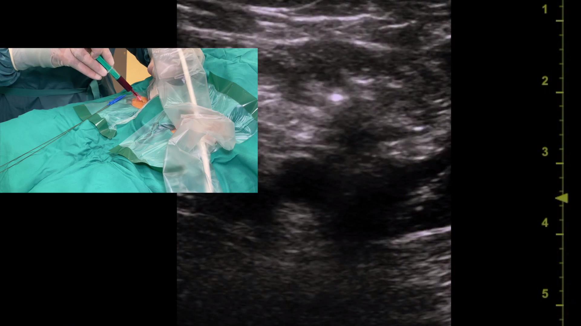 如何使用超声穿刺腹股沟血管