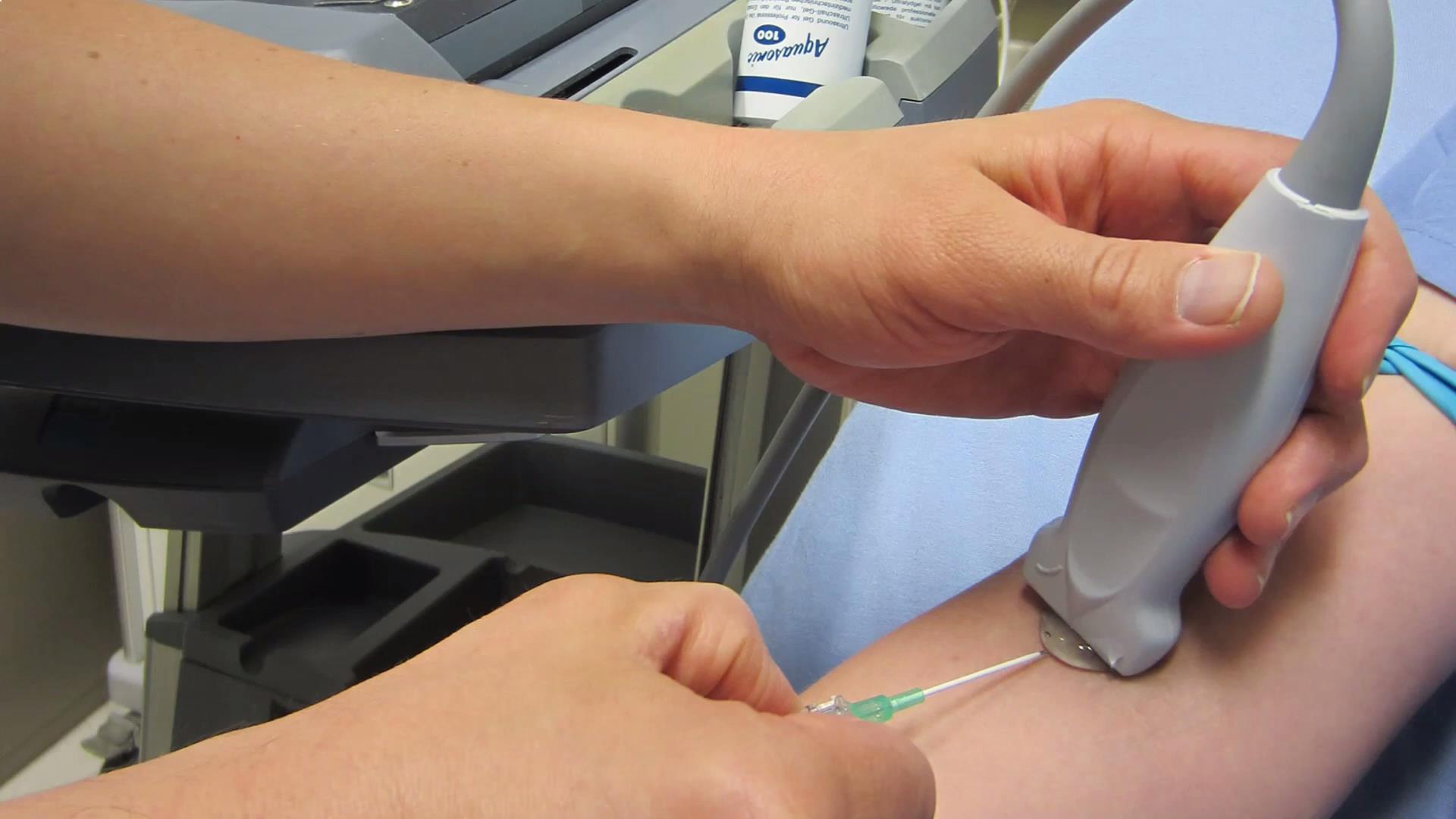 超声引导下静脉通路建立