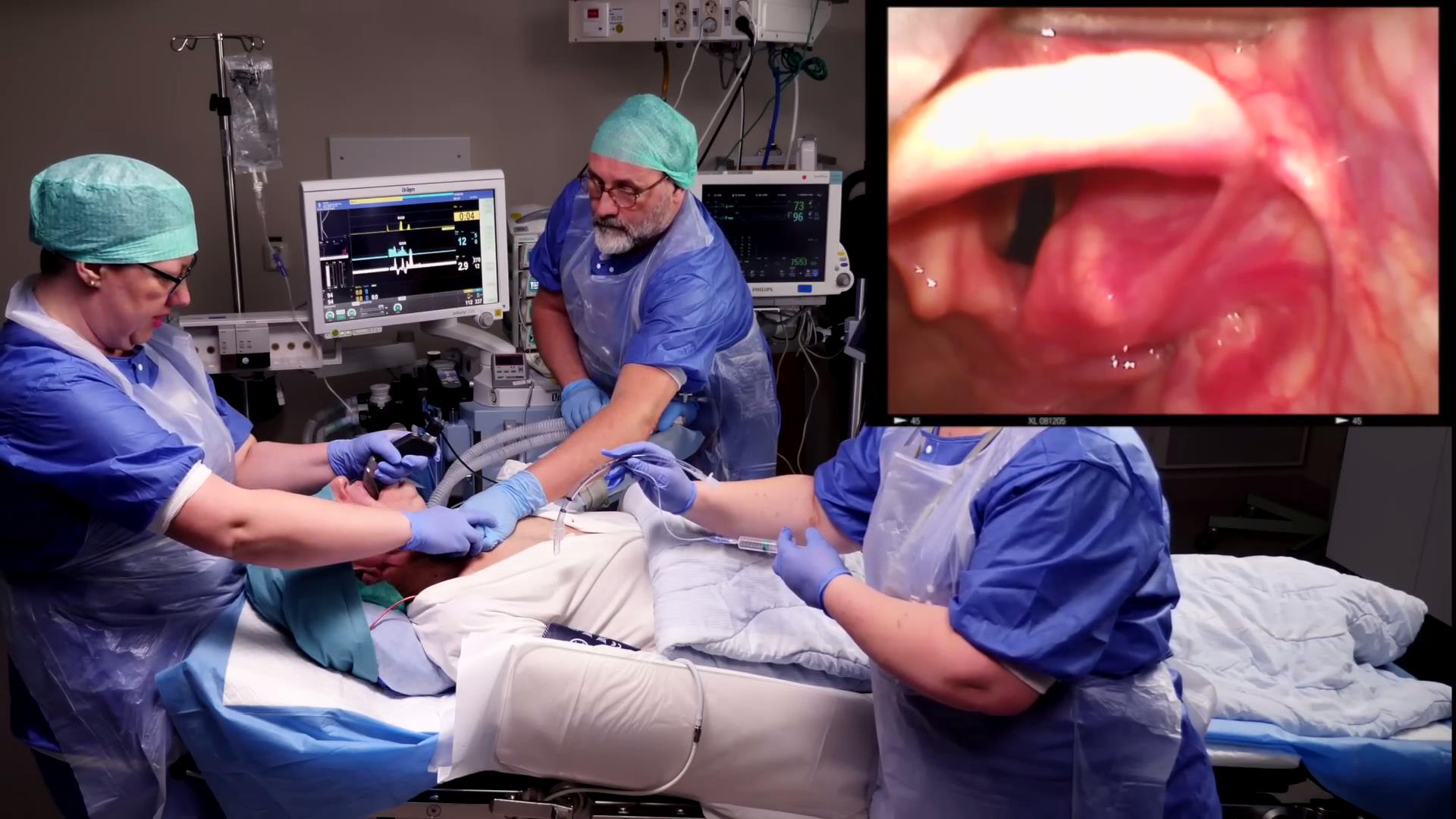 经口气管插管操作高清视频