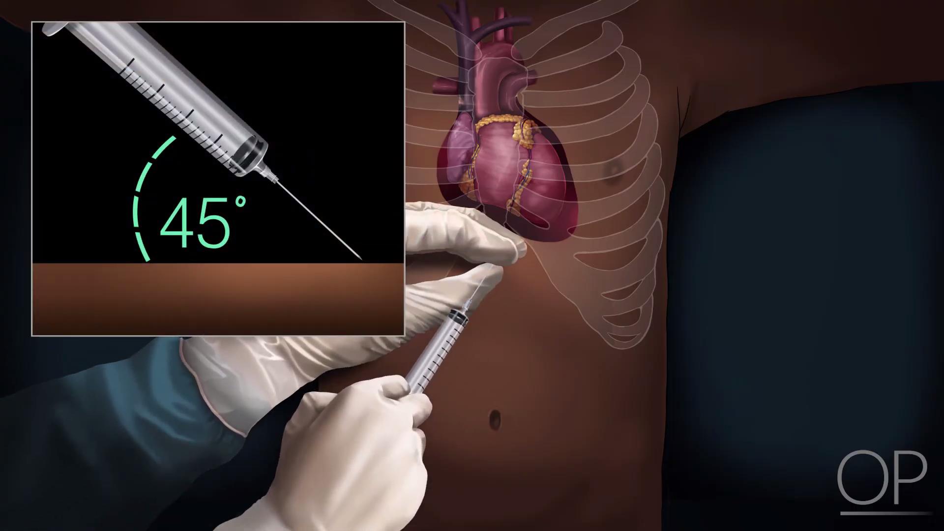 《心肺复苏期间的心包穿刺术》