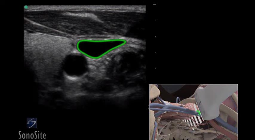 如何操作：超声引导下置入颈内静脉长导管 3D 视频