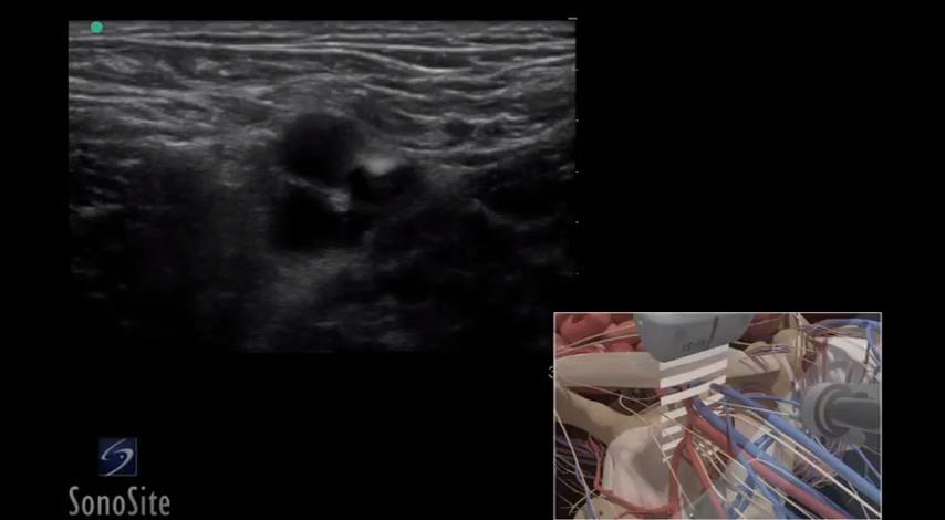 超声引导下置入股静脉导管 3D 视频