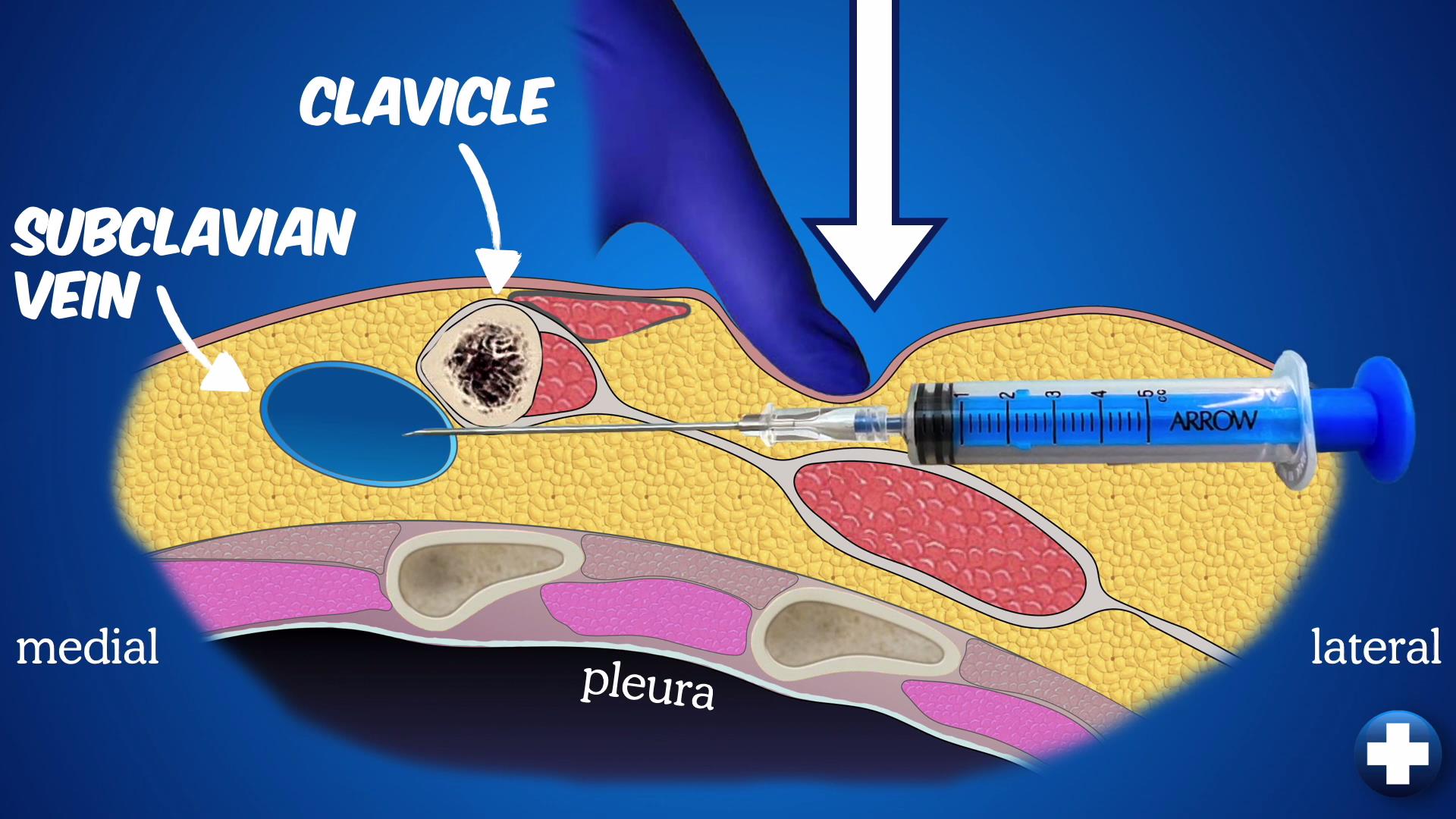 锁骨下中心静脉置管操作高清视频（简便安全的体表标志定位法）
