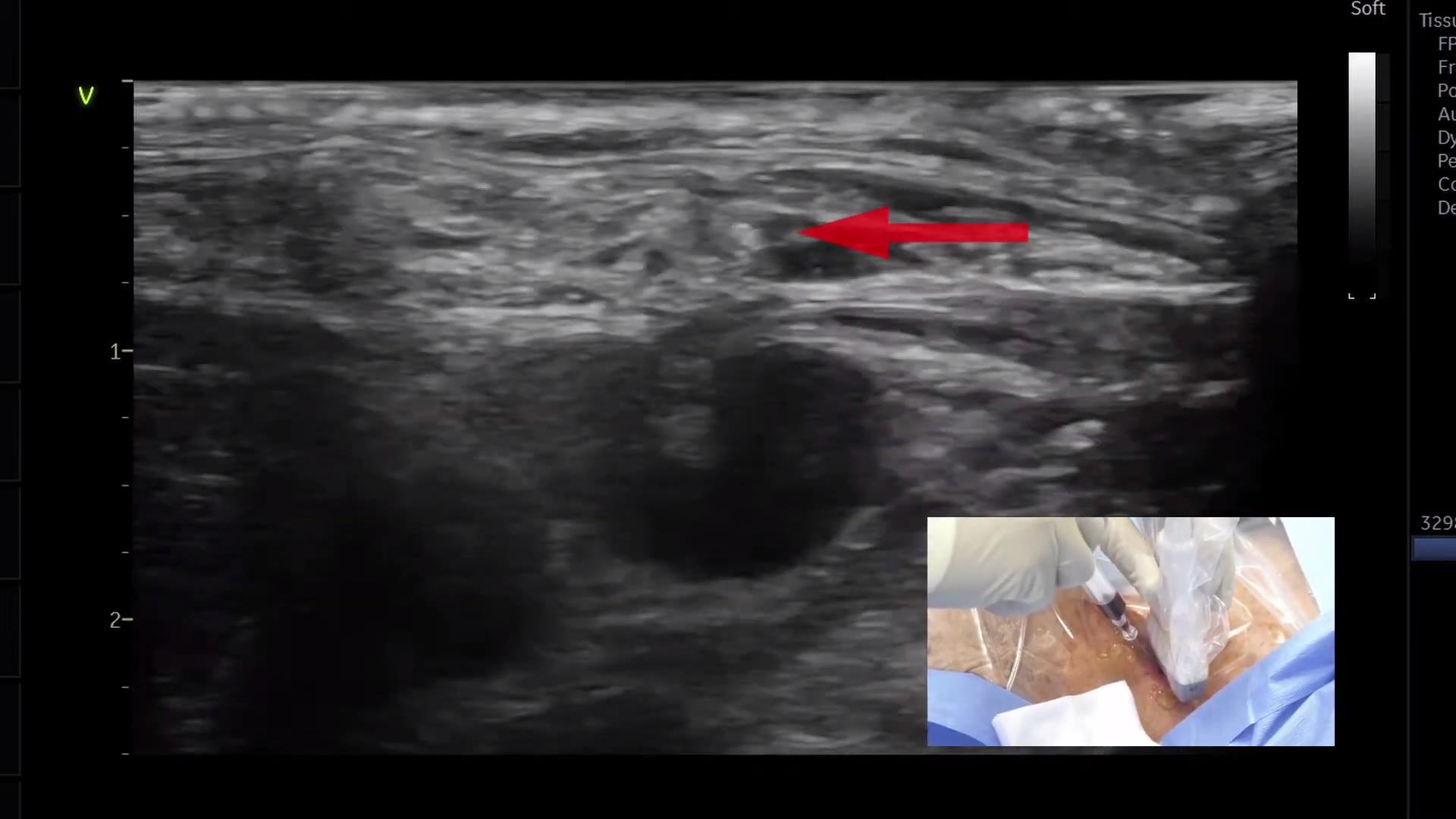 中心静脉置管术（颈内静脉）B超定位下操作高清视频