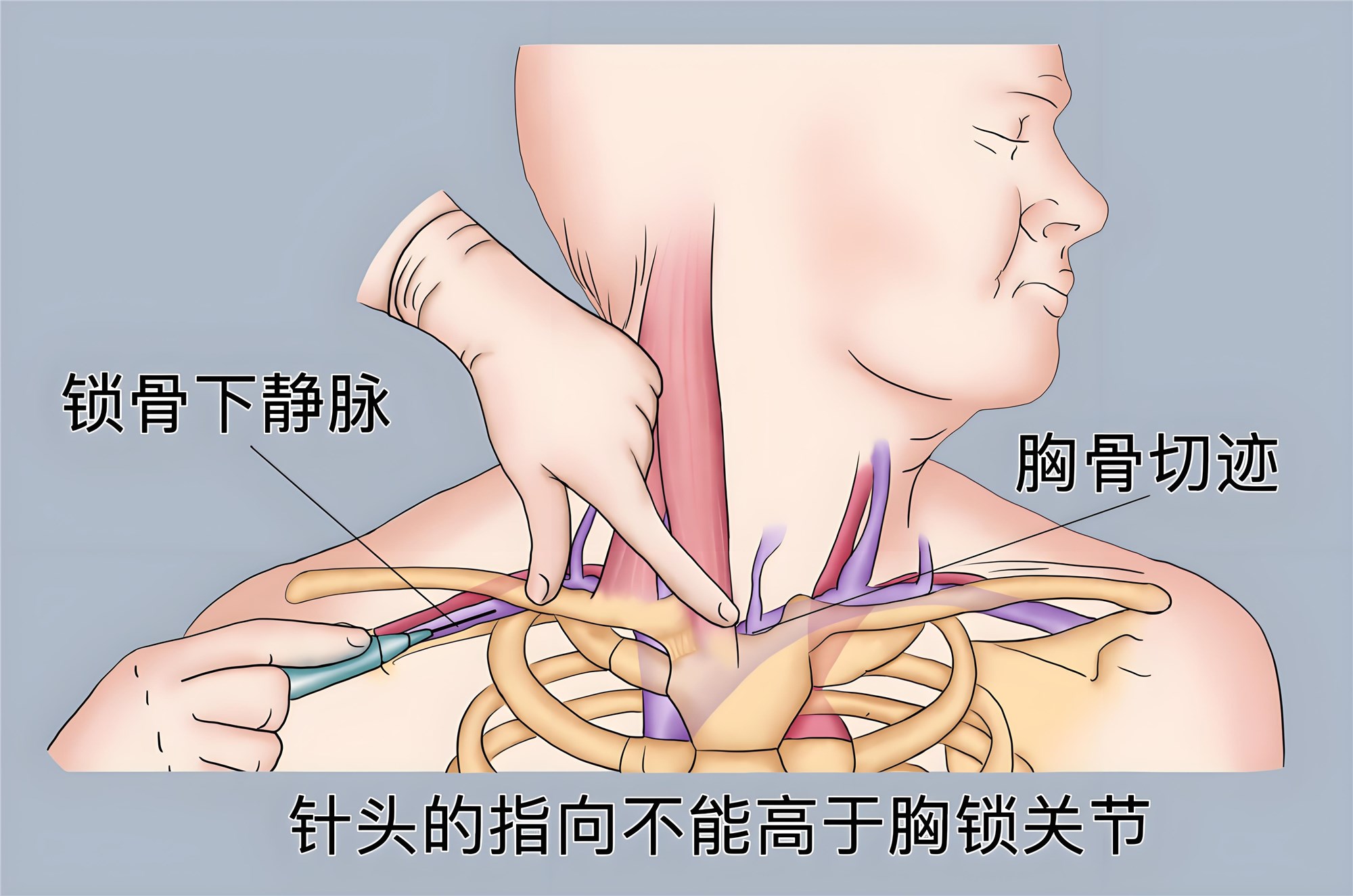 超声引导平面内锁骨下静脉穿刺置管