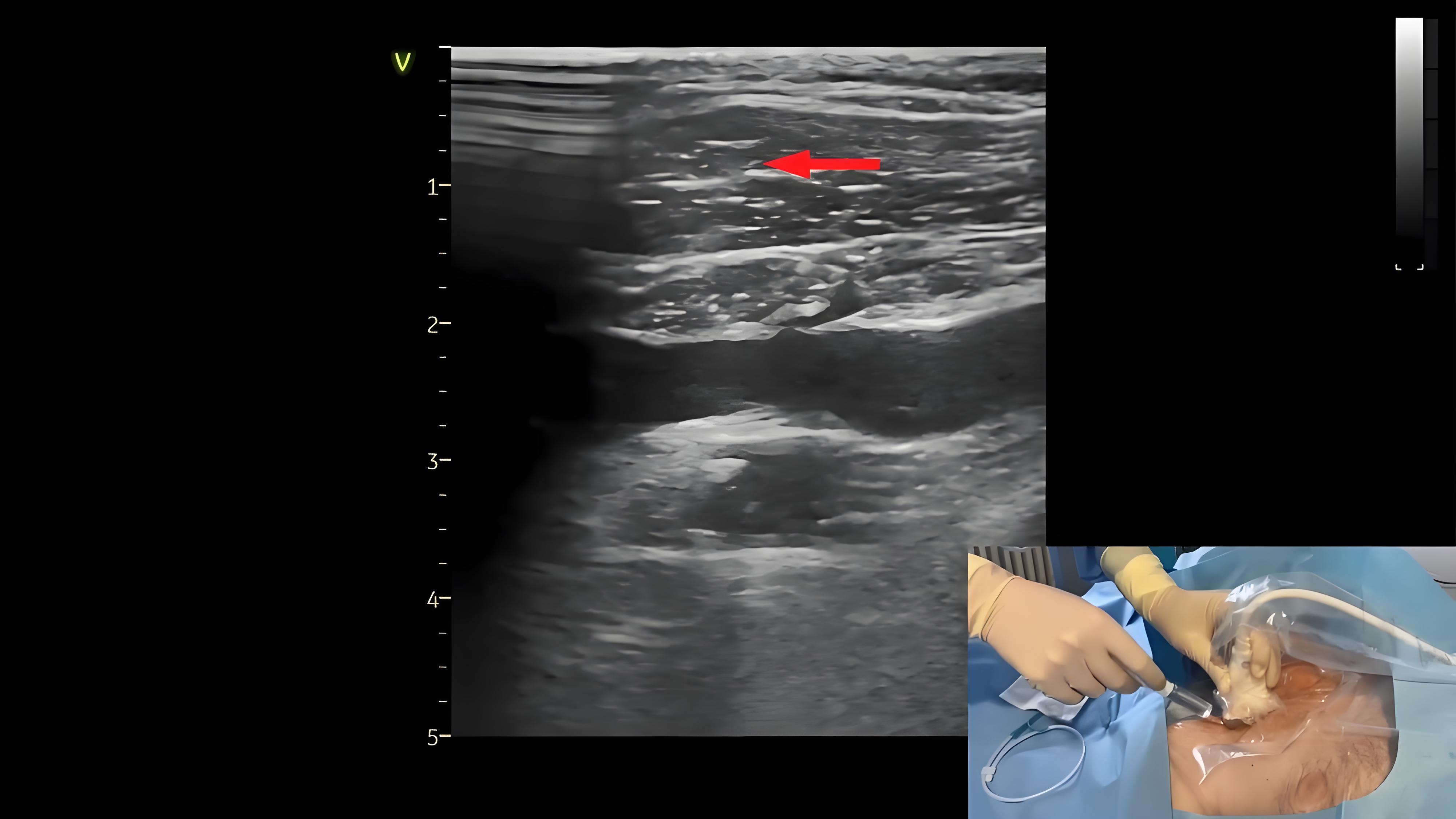 手把手操作：彩超引导下锁骨下静脉穿刺