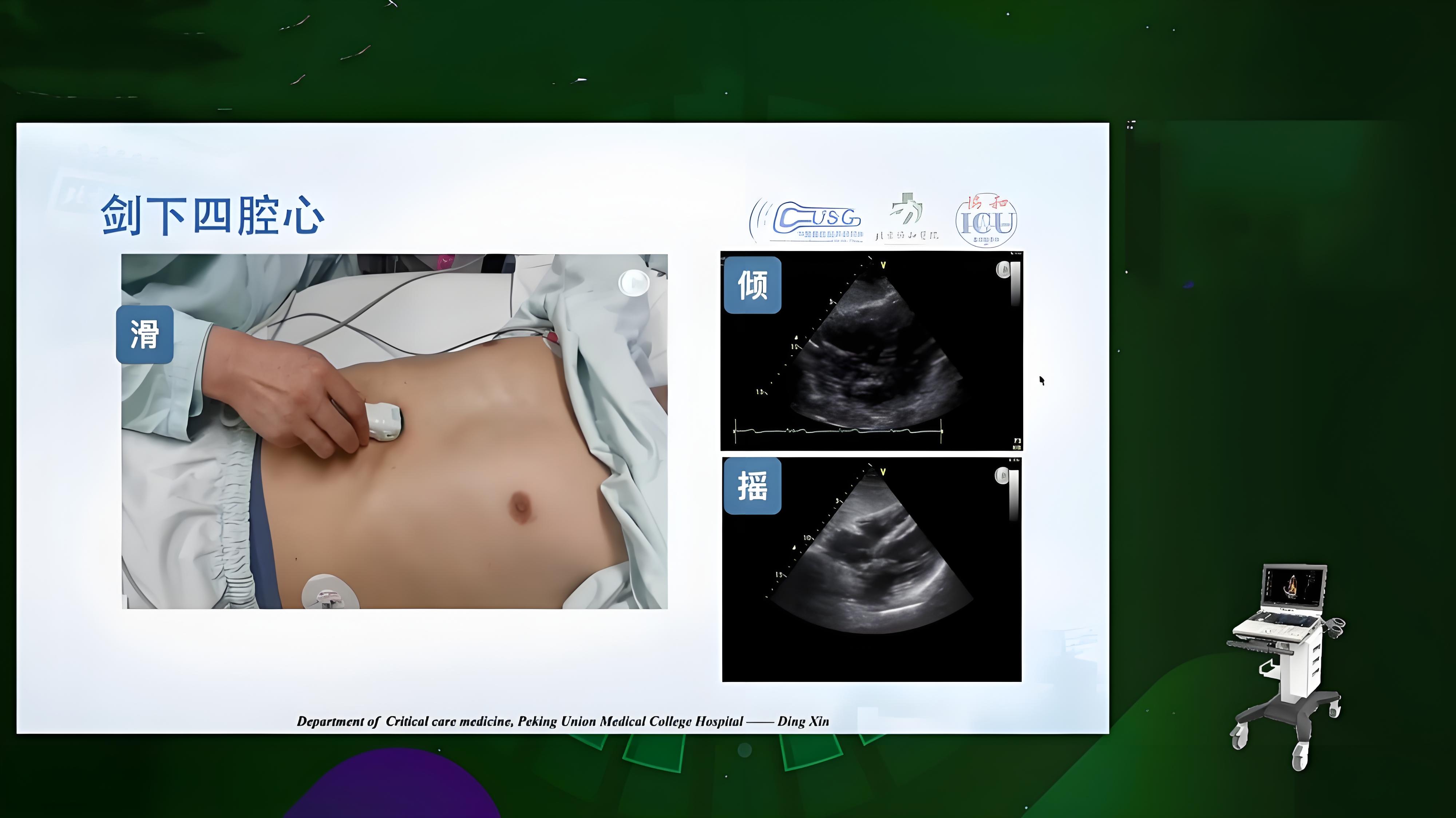 “剑突下四腔心”切面的获取