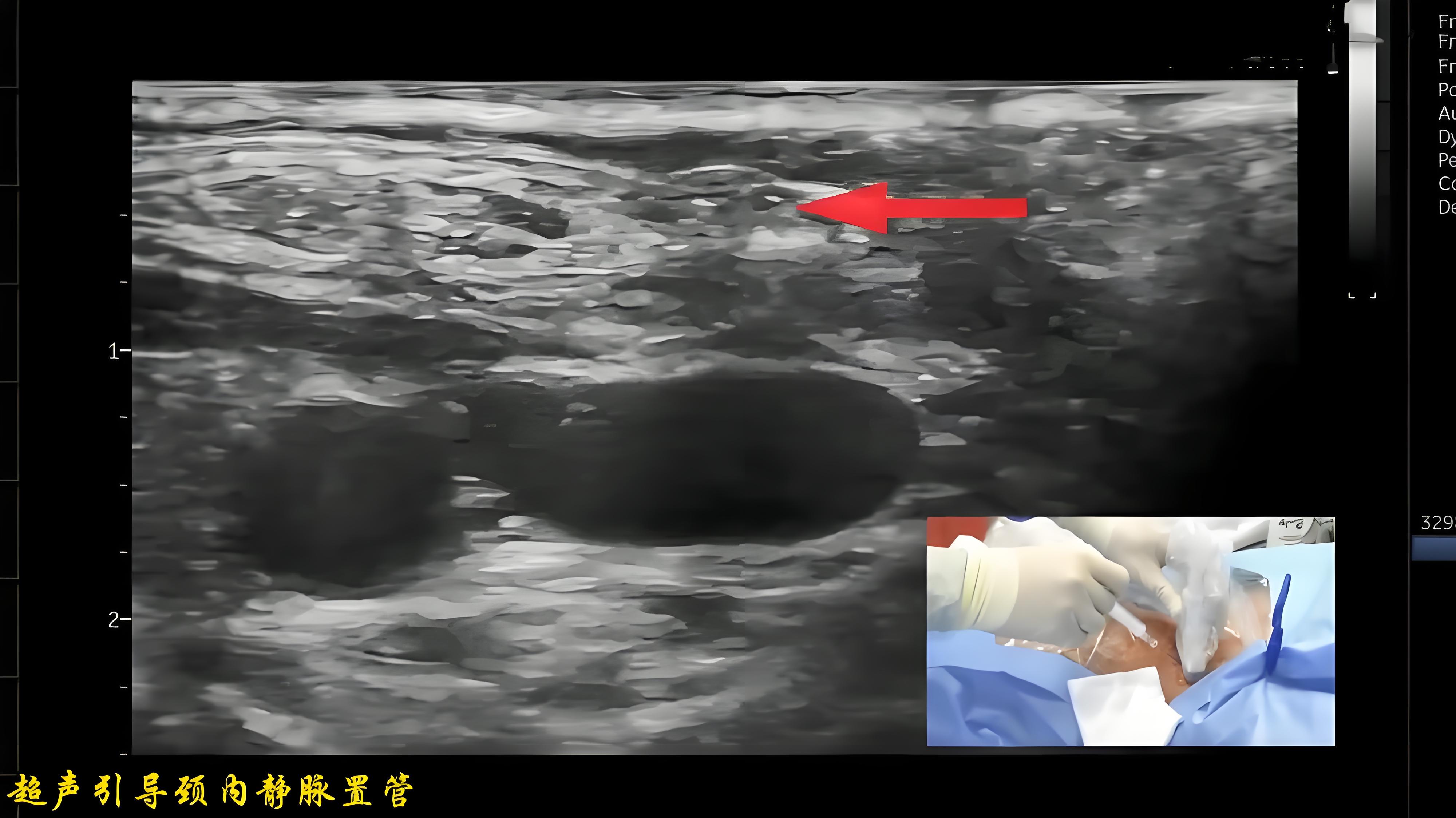 超声实时引导下颈内静脉穿刺置管