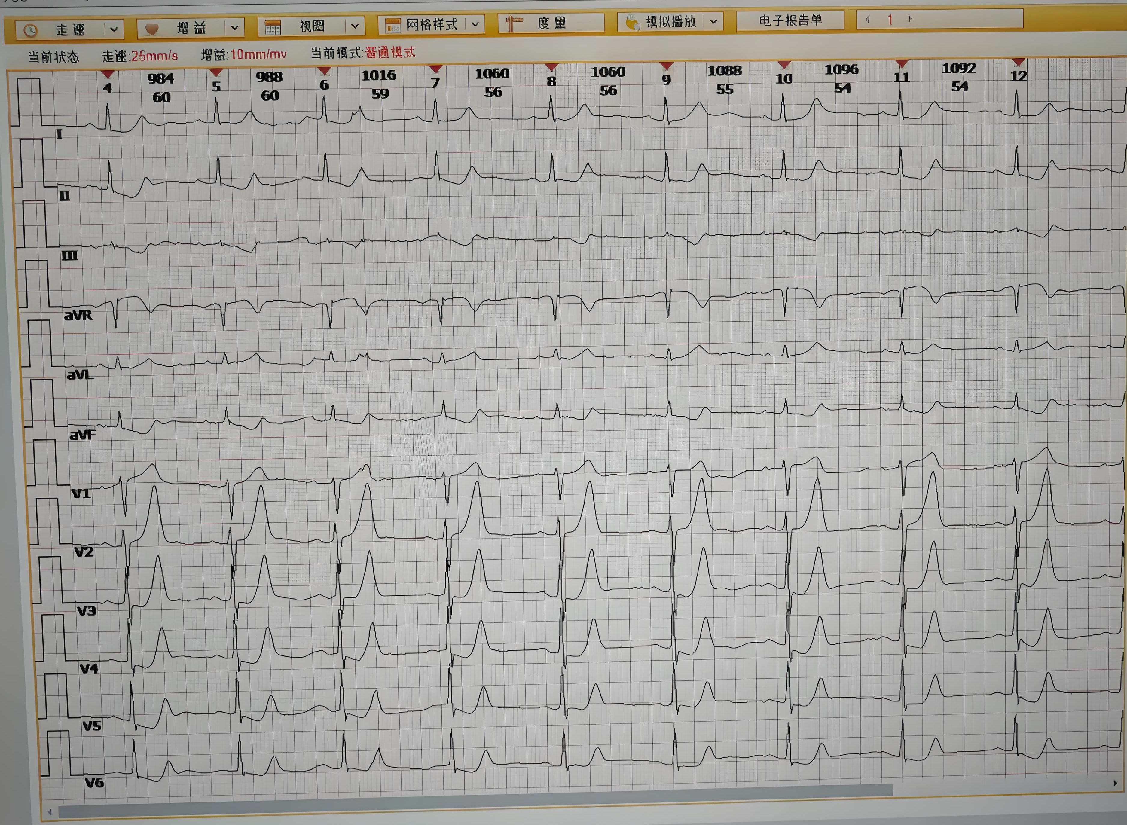 De Winter综合征全面解析与典型病例报告-第1张图片-医海无涯