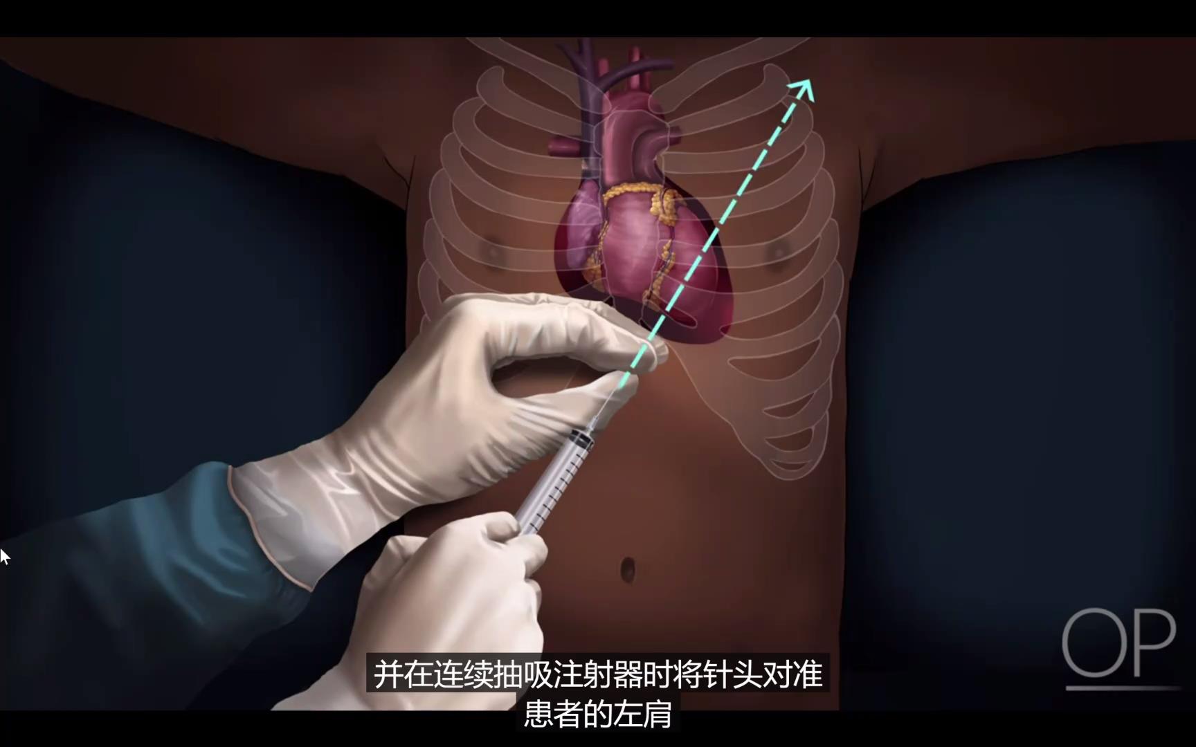 急诊紧急心包穿刺术